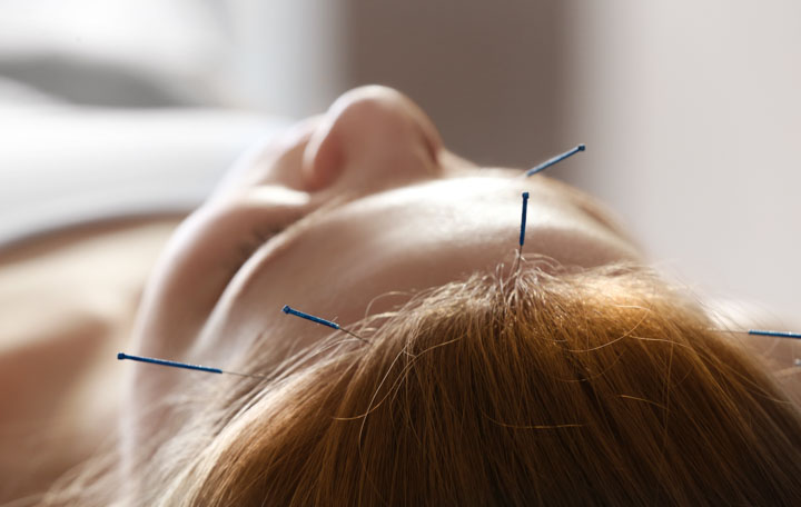 Acupuncture on the forehead and glabella