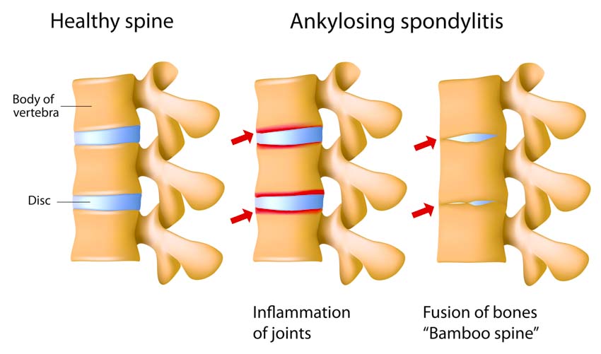 ankylosing spondylitis