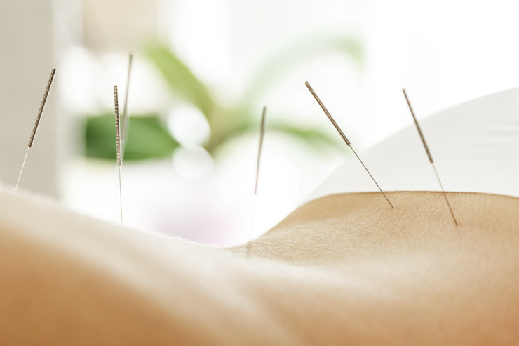 Acid reflux acupuncture treatment. 