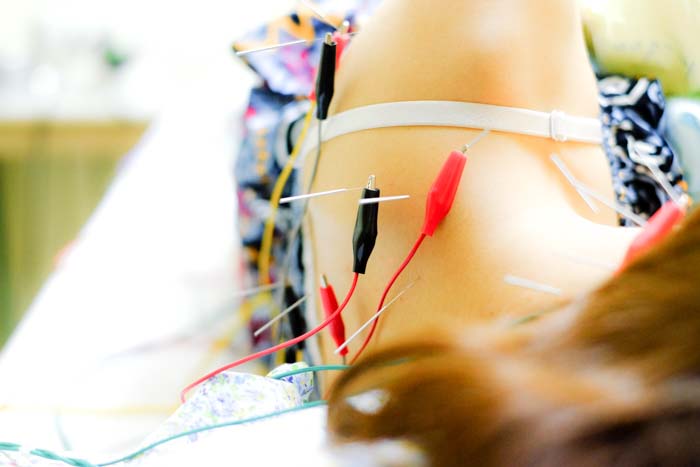Electroacupuncture on a woman's back