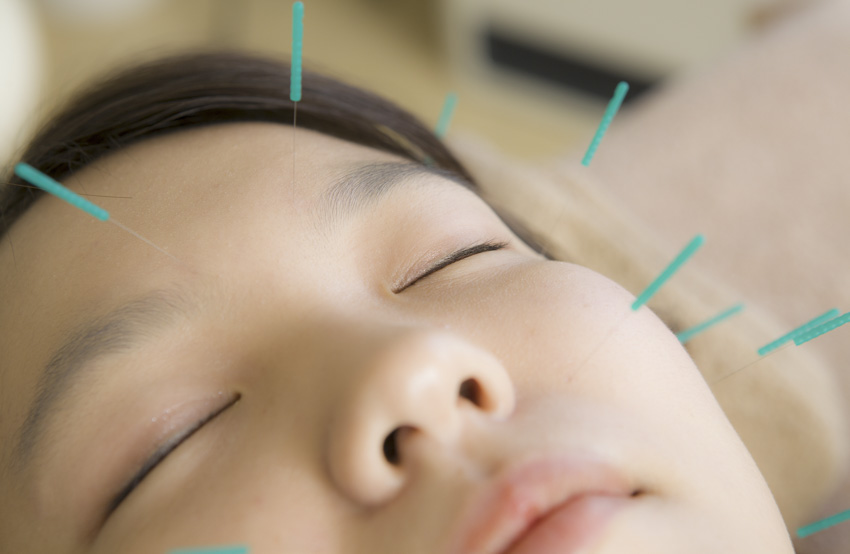 Bells Palsy Acupuncture