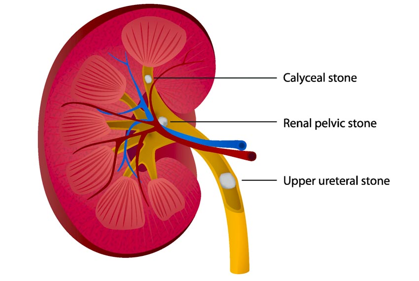 kidney stones