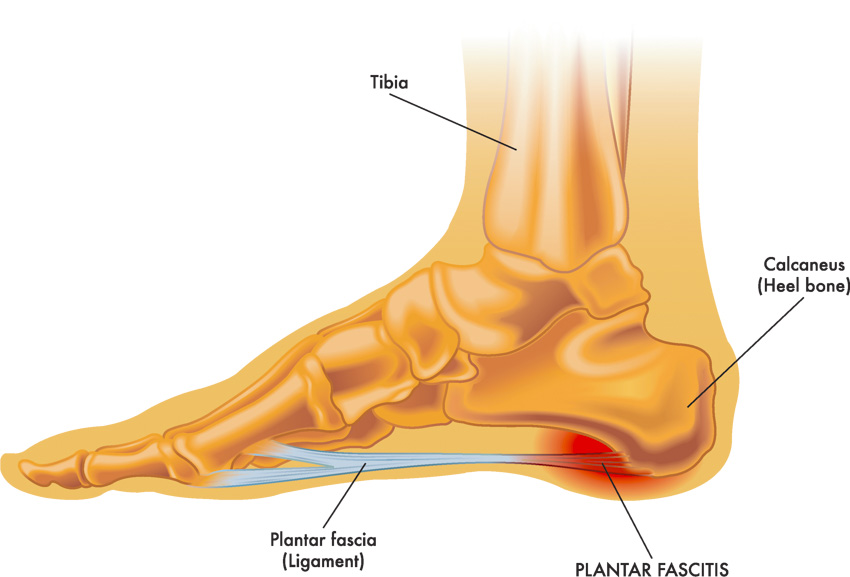 Reflexology Chart For Plantar Fasciitis