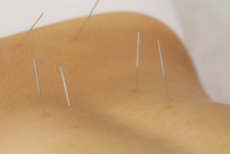 Lower back acupuncture points
