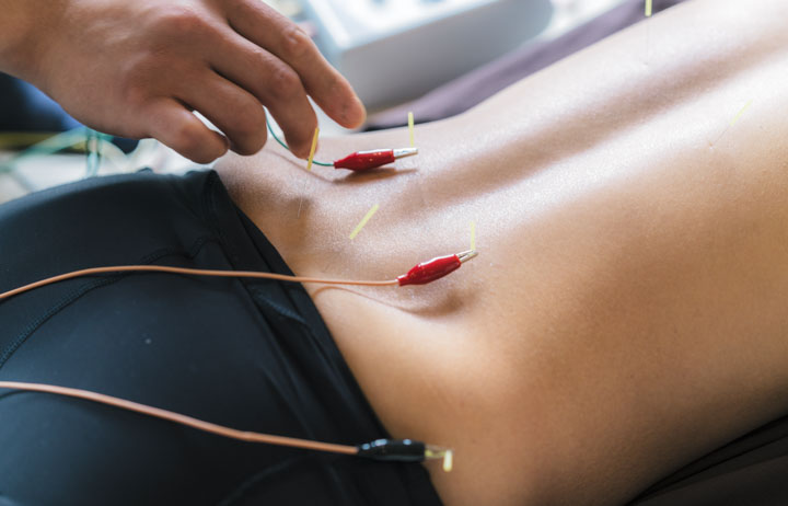 Seirin needles with electroacupuncture stimulation of the lower back