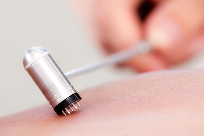 Acupuncture Combats Baldness, Outperforms Drug Therapy Acupuncture Combats Baldness, Outperforms Drug Therapy