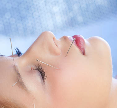 Facial needling in the TCM syle. 