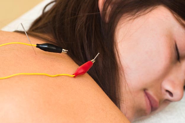 Electroacupuncture applied to upper back and neck points is shown. 