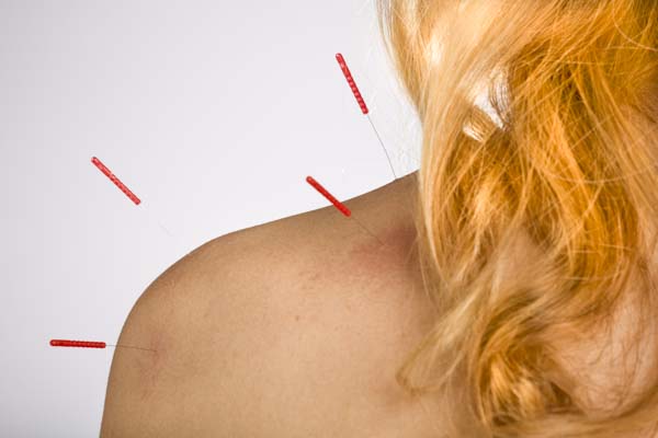 Hui style acupuncture involves application of Ashi points. 
