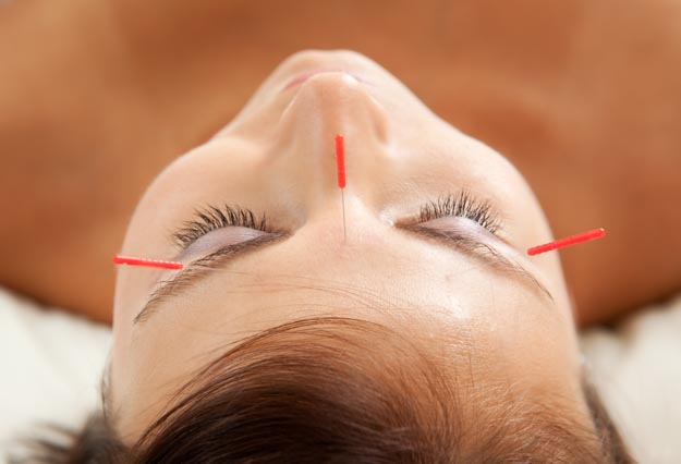 Facial needles for migraine relief. 