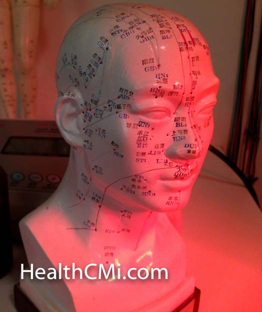 Scalp points for needling a stroke patient. 