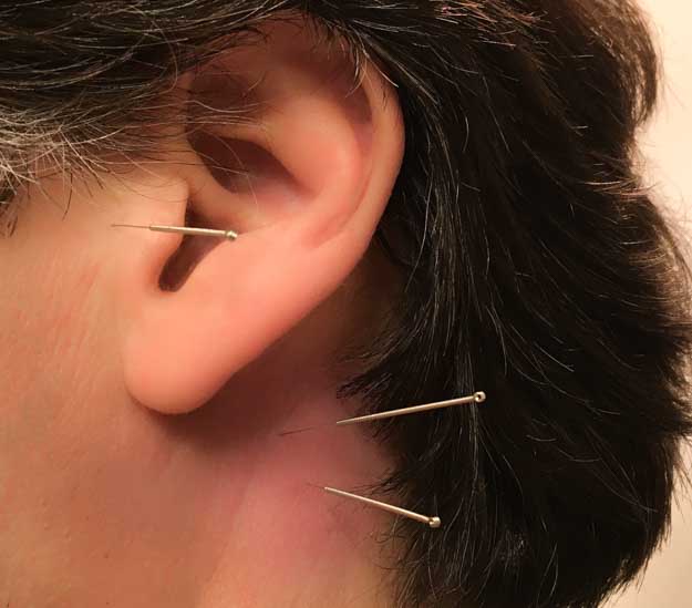 Acupuncture Tinnitus | transcend.ihrm.or.ke