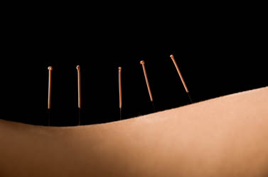 Back shu points with copper wound needles. 