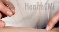 Copper handle filiform needle applied by an acupuncturist. 
