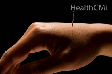 Copper handled needle on LI4 of women's hand. 