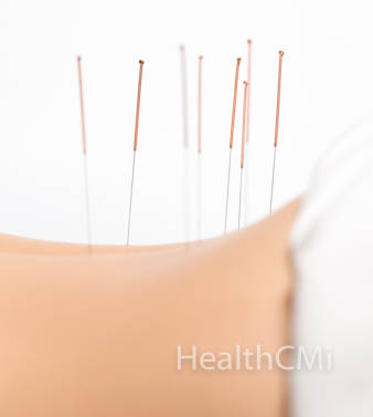 Copper handled acupuncture needles on the back at the lumbar vertebrae. 