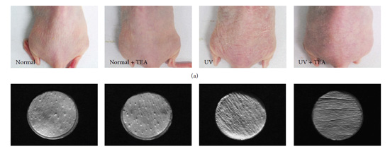 Acupuncture Reduces Wrinkles And Provides UVB Protection