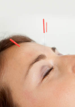 Acupuncture treatment for the eyes. 