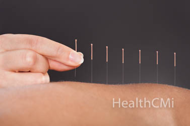 Safety in Acupuncture 