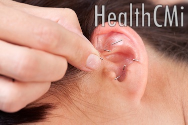The photo shows a woman receiving acupuncture needles on the ear at shenmen and other acupoints. 