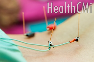Back electro treatment is depicted with copper wound needle. 