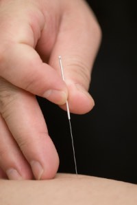 Individual needle insertion is shown here. 