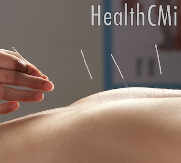 Acupuncture Boosts Energy For Chronic Fatigue Patients