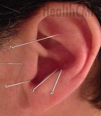 Auricular Points