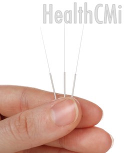 Close-up of three acupuncture needles with a wound stainless steel handle and Chinese style tip. 