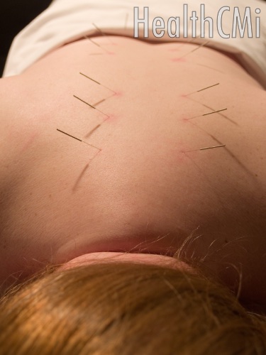 Back shu points shown releasing inflammation. 
