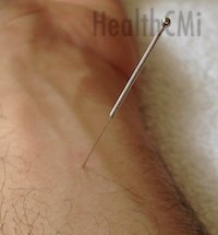 Application of P6 is shown in this photo with a filiform needle. 