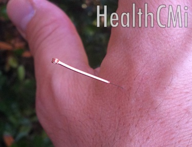Acupuncture point Hegu (LI4) is needled here. 
