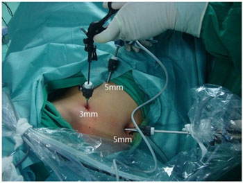 Acupuncture relieves pain associated with laparoscopic surgery pain. 