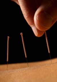 Acupuncture helps professional athletes perform. 