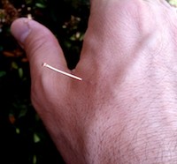 Acupuncture is shown applied to acupoint LI4. 