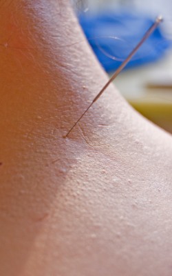 Acupuncture may be applied to the neck directly. 