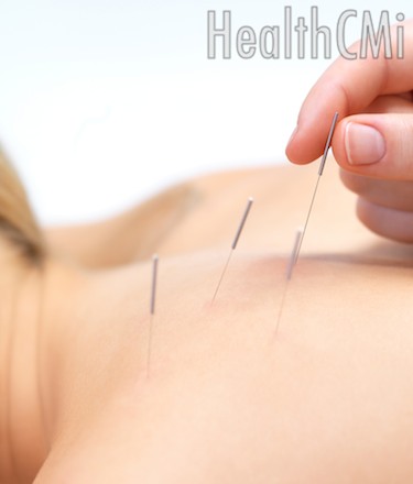 The new findings prove that acupuncture reduces hot flashes by over 30 percent. 