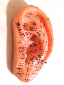 Auricular acupuncture for weight loss is shown here. 