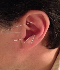 Ear acupuncture for the treatment of obesity and hunger is depicted here. 