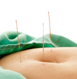 Local and distal needling for IBS is effective for pain reduction and reducing digestion disorders. 