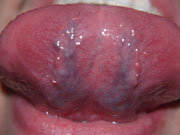 A view of the underside of the tongue for tongue diagnosis. 