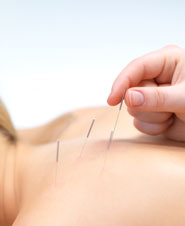 Acupuncture applied to the back is depicted here. 