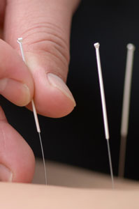 Acupuncture reduces lower back pain.