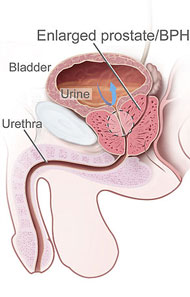 prostate enlargement tcm)