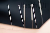 An image of stainless steel needles in the back of a person is shown here. 