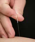 acupuncture-needle