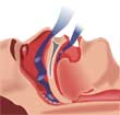 acupuncturesleepapnea