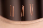 09ibackpainacupuncture19072018