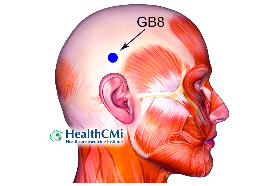 acupuncture migraine GB8 25af