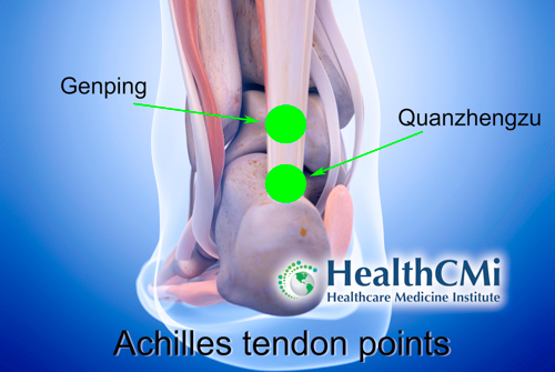 Acupuncture For Achilles Tendinopathy